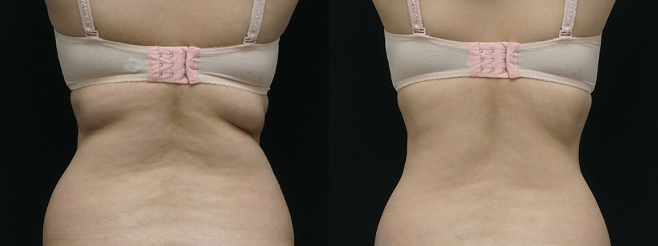 fat freezing