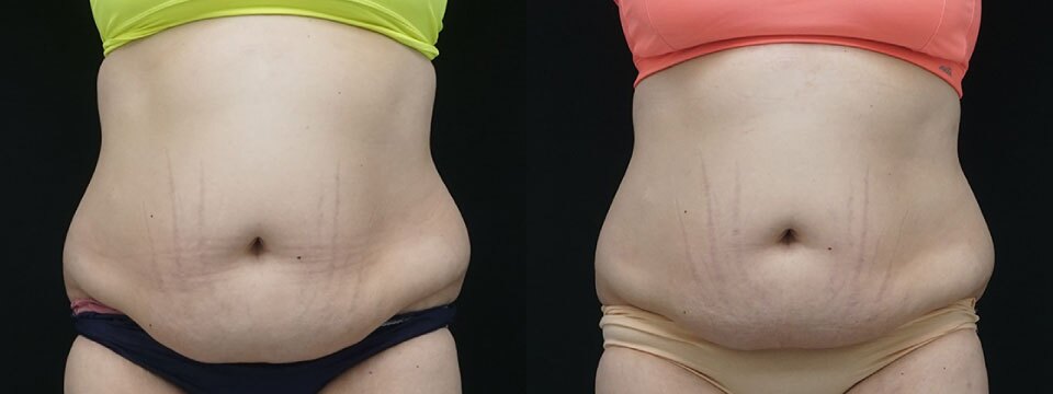 fat freezing
