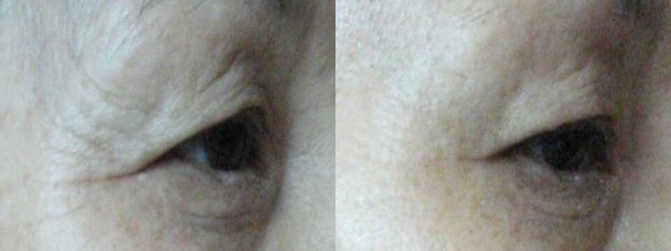 non surgical upper and lower blepharoplasty