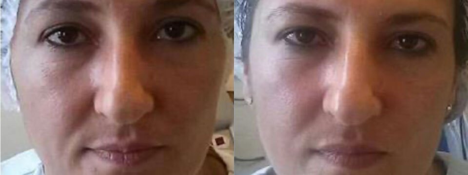 skin rejuvenation