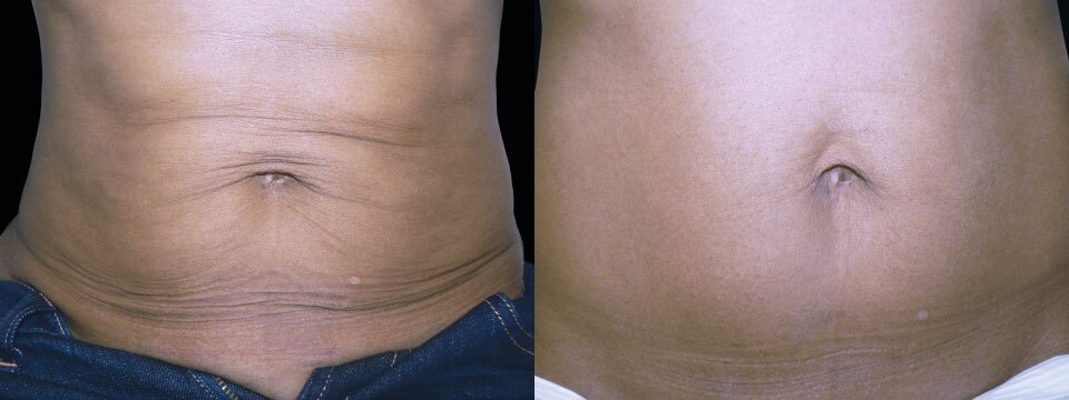 skin tightening