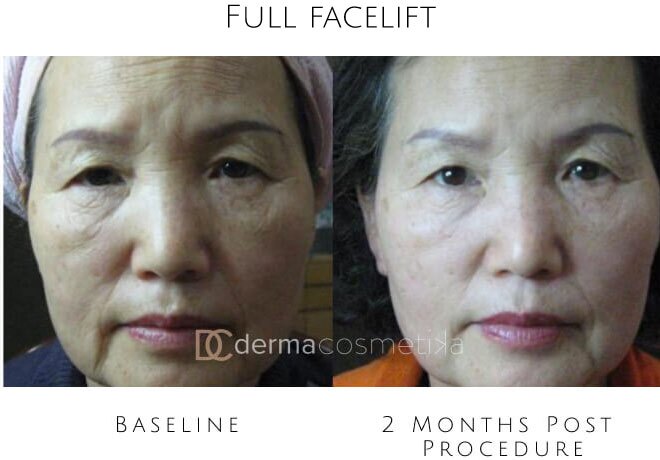 hifu before after