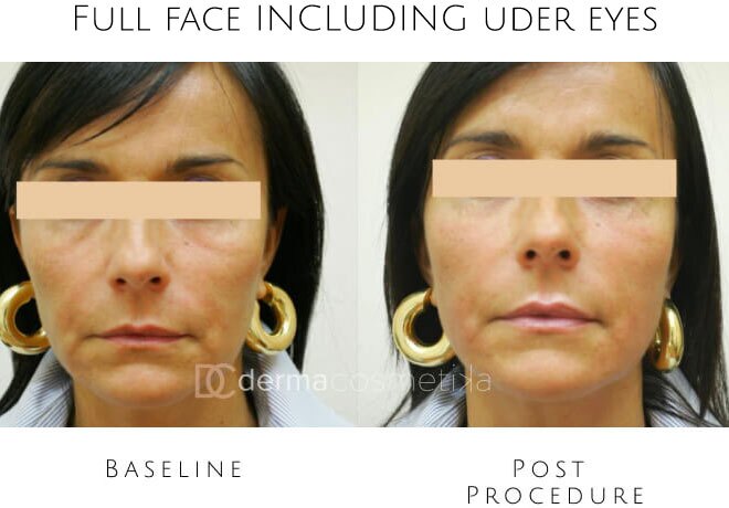 hifu before after