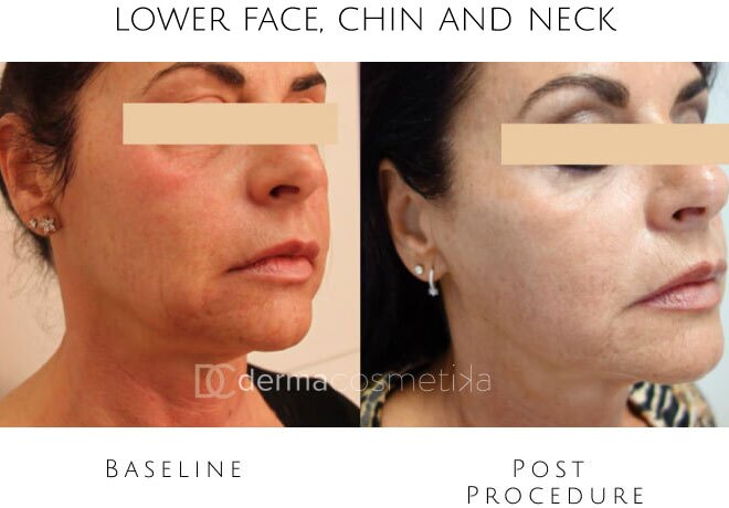 hifu before after