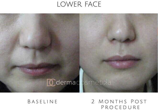 hifu before after