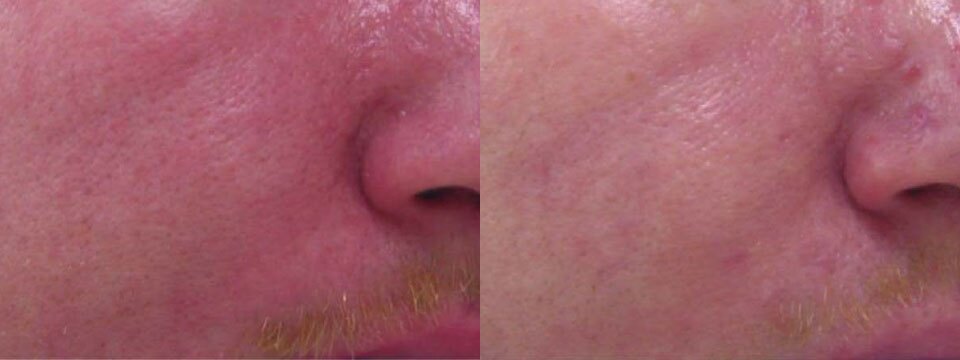 rosacea