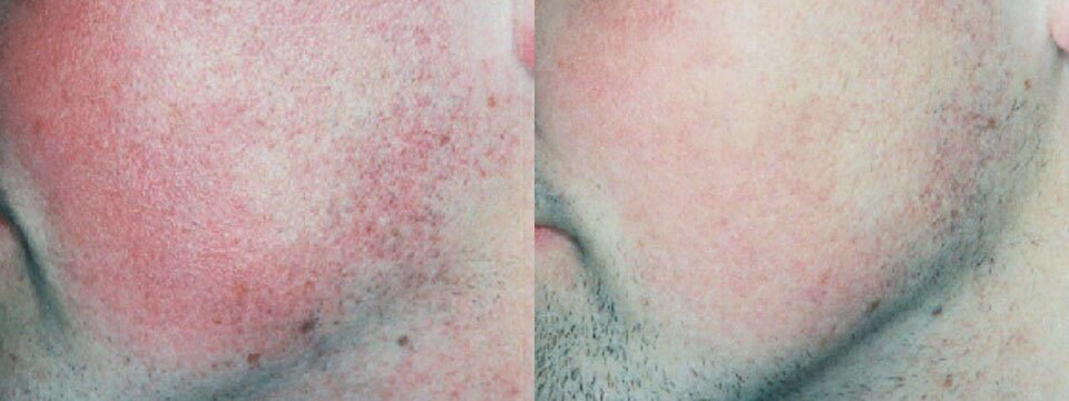 vascular lesions