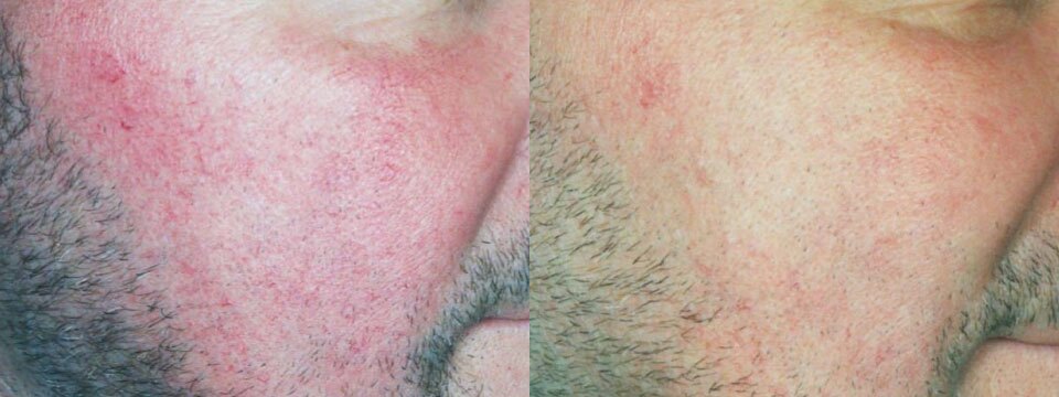 vascular lesions