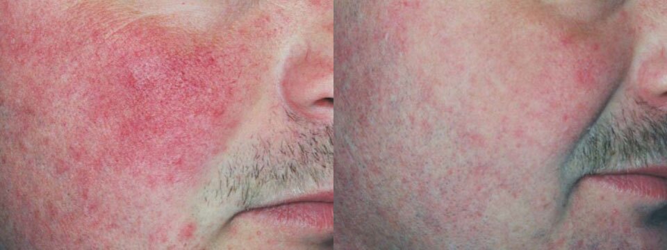 vascular lesions