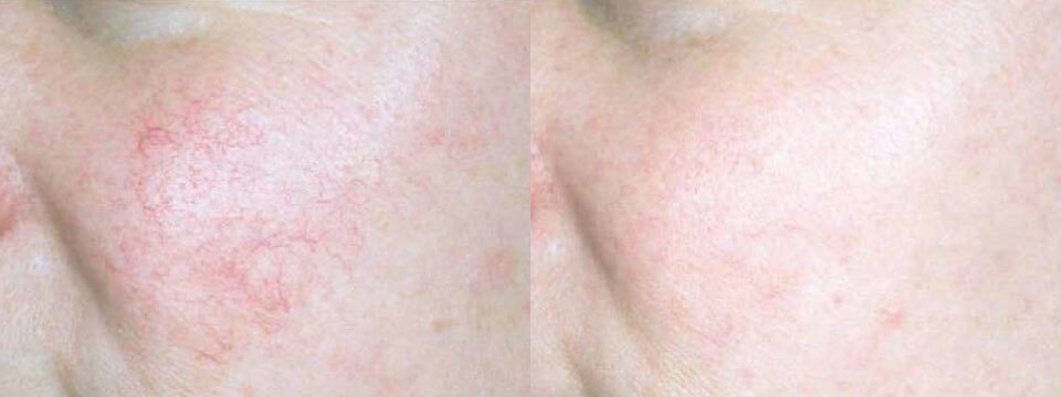 vascular lesions