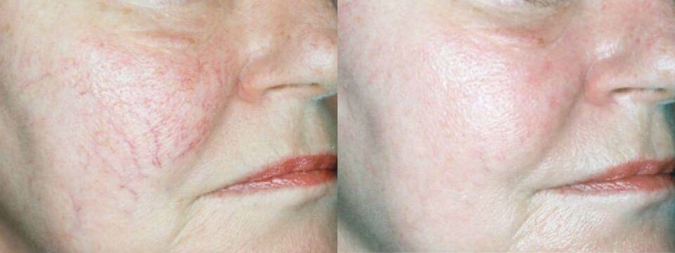 vascular lesions