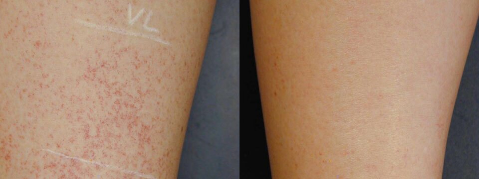 vascular lesions