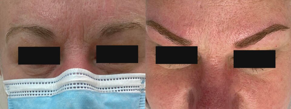 cosmetic tattooing