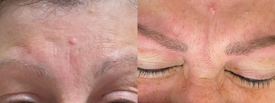 cosmetic tattooing