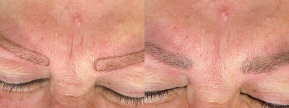 cosmetic tattooing