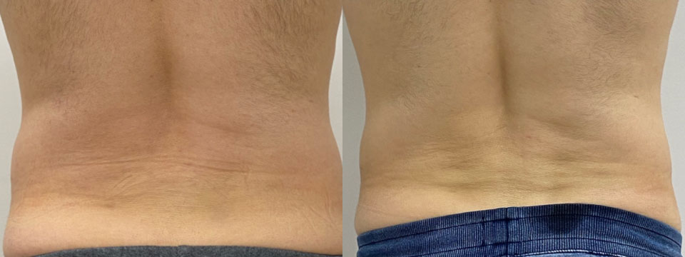 fat freezing