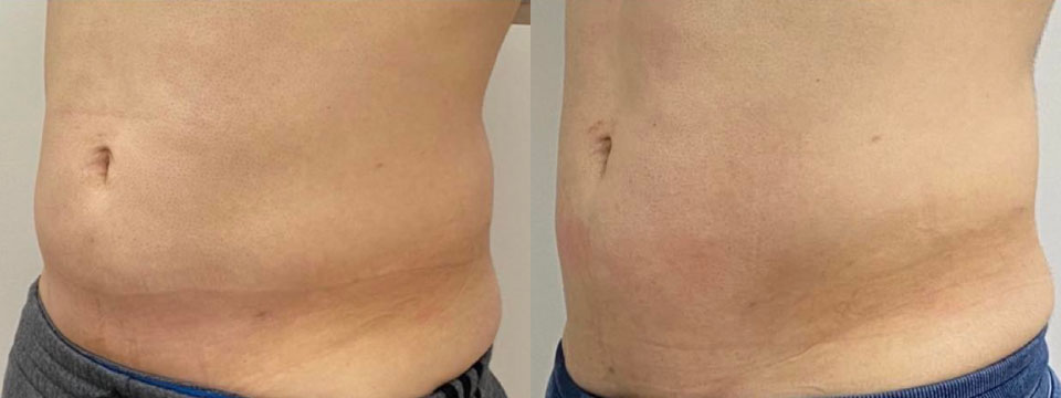 fat reduction