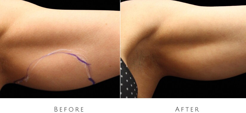 skin tightening before after