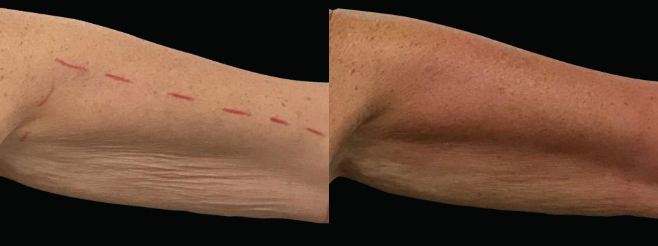 Arms Fat Reduction and Skin Tightening