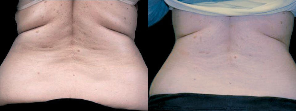 Flanks Love Handles and-Bra-folds-Skin-Tightening and Fat Reduction