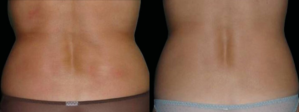 Flanks Love Handles and-Bra-folds-Skin-Tightening and Fat Reduction
