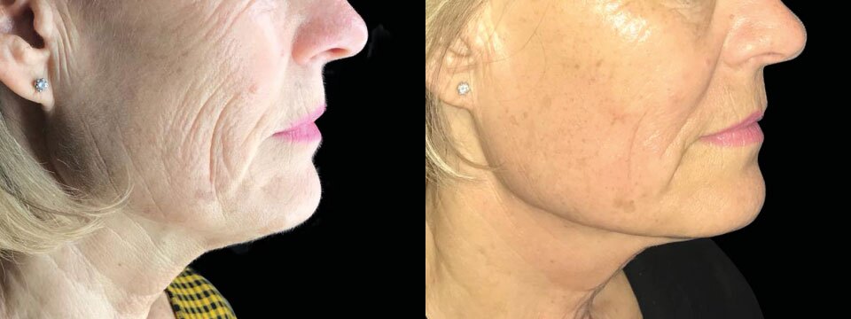 anti-wrinkle treatment