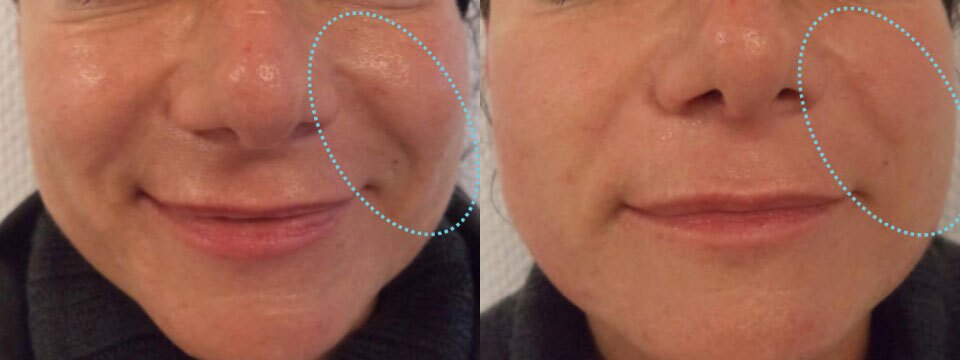 anti-wrinkle treatment