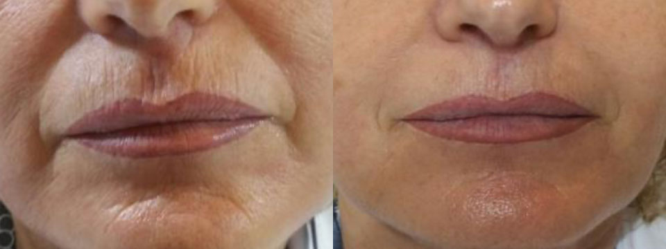 anti-wrinkle treatment