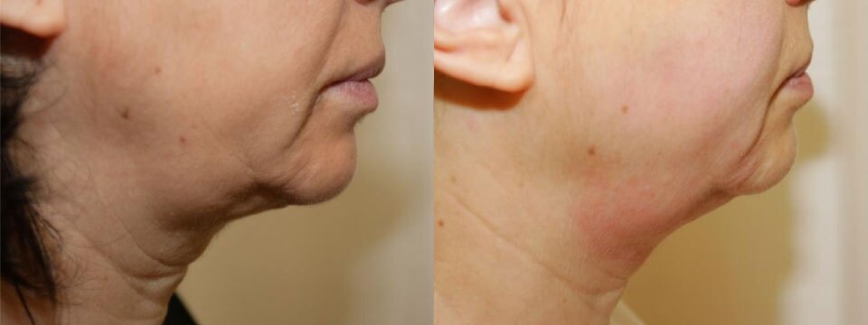 anti-wrinkle treatment