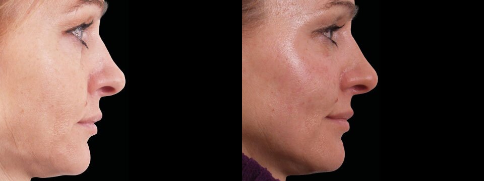 non surgical face lift