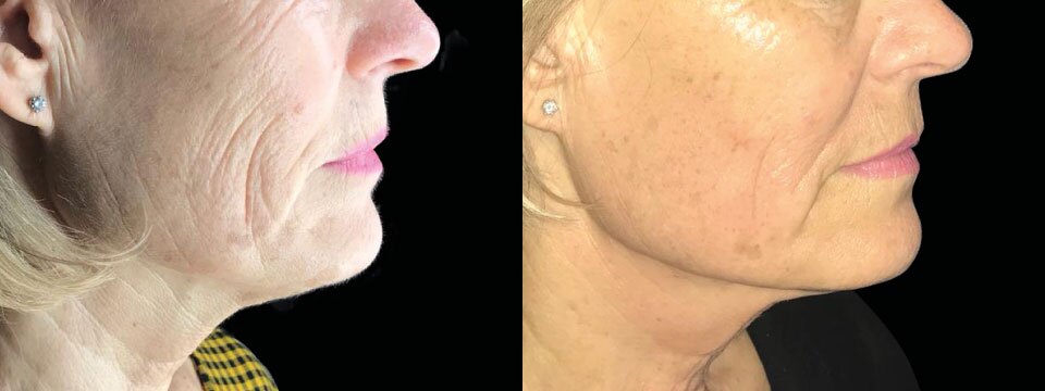 non surgical face lift