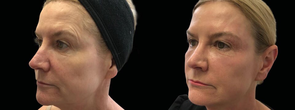 non surgical face lift