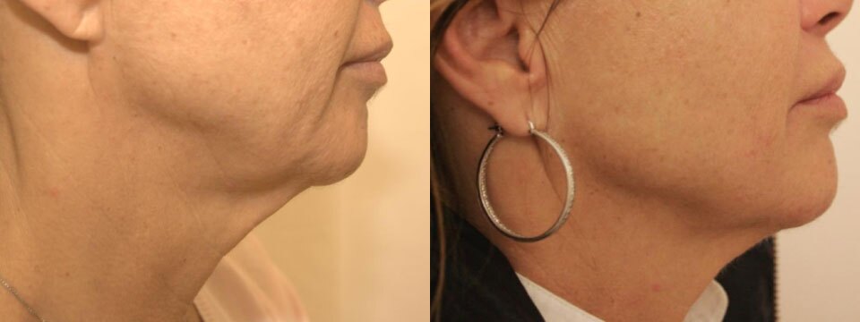 non surgical face lift