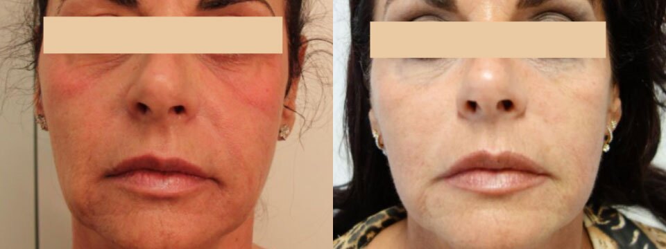 non surgical face lift