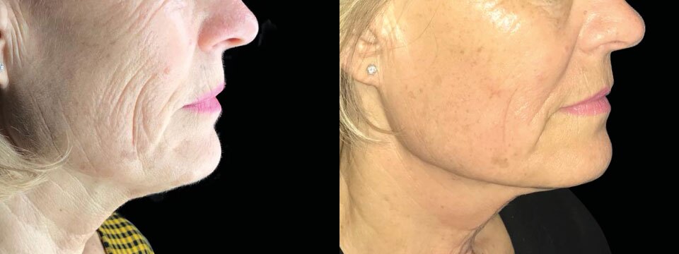 non surgical neck lift