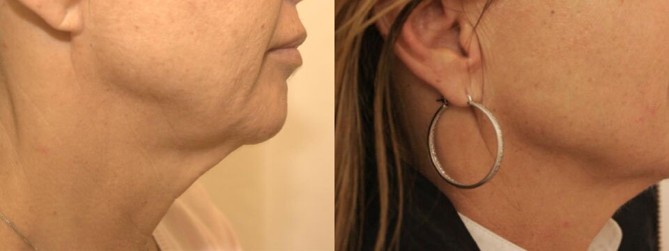 non surgical neck lift
