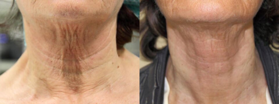 non surgical neck lift