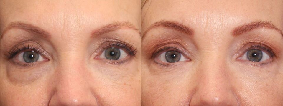 non surgical upper and lower blepharoplasty