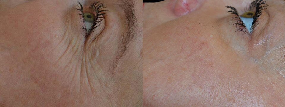 non surgical upper and lower blepharoplasty