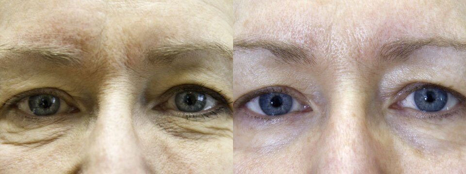 non surgical upper and lower blepharoplasty