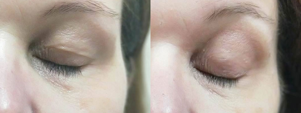 non surgical upper and lower blepharoplasty