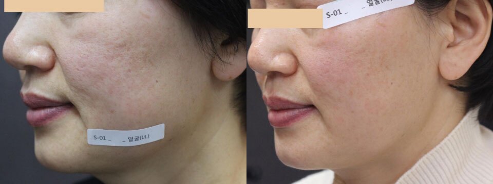 skin rejuvenation
