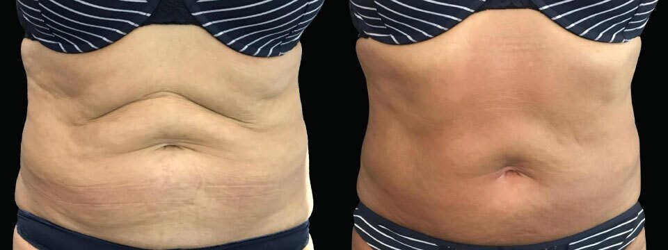 skin tightening lifting