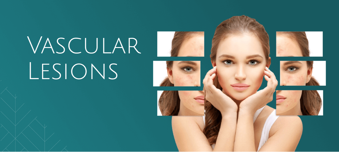 Vascular Lesions