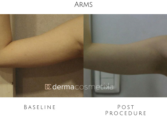 hifu arms before after