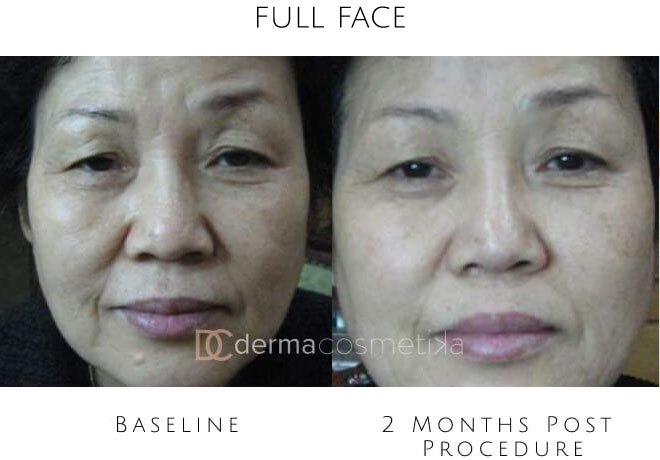 hifu before after