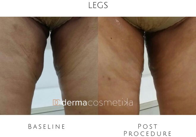 hifu legs before after
