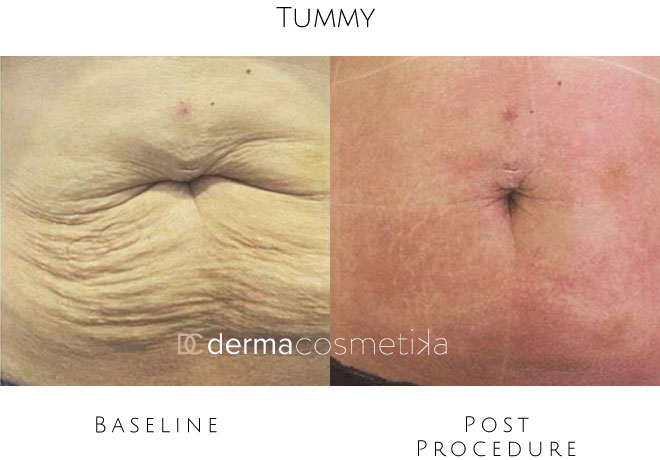 hifu tummy before after