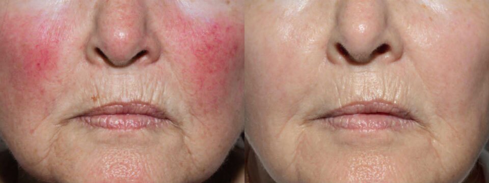 rosacea