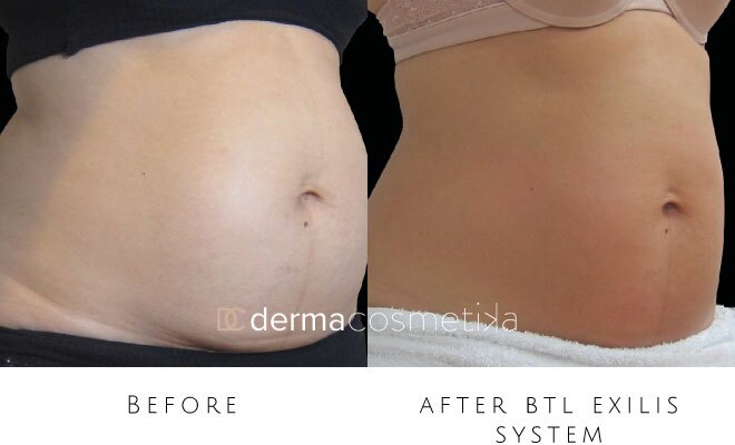 exilis before after
